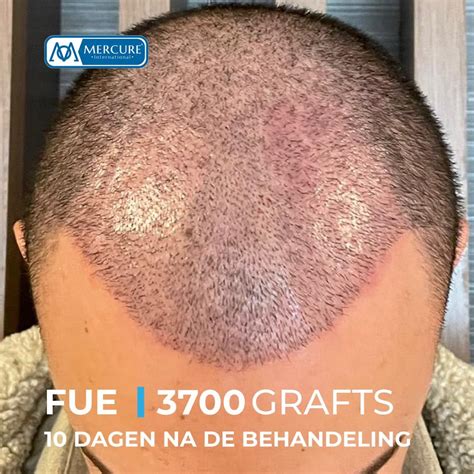 Haartransplantatie Saffier FUE: Waarom Het De Beste Keuze Is