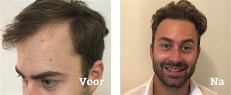 Haartransplantatie Behandeling: Wat Te Verwachten Tijdens Het Proces?