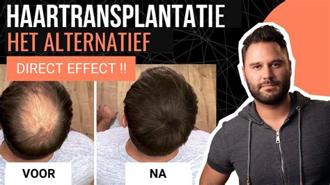 Haartransplantatie Kosten Vergelijken: Tips En Adviezen