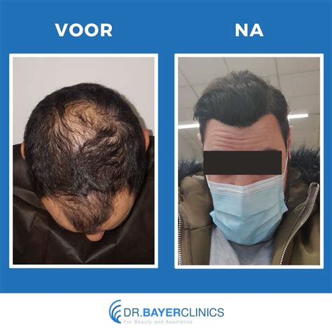 Haartransplantatie En Na Zorg: Belangrijke Tips