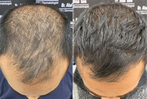 PRP En Haartransplantatie: Een Perfecte Combinatie?
