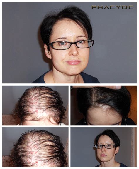 Vertrouwen Opbouwen Voor Je Haartransplantatie