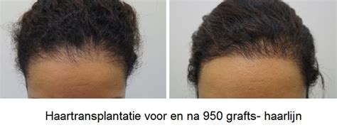 Bereid Je Voor Op De Herstelfase Van Haartransplantatie