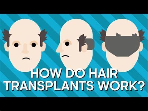 De Geschiedenis Van Haartransplantatie: Van Begin Tot Nu