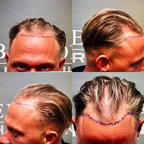 De Rol Van Haartransplantatie In De Schoonheidsindustrie