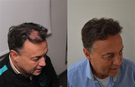 Haartransplantatie Bij Mannen: Wat Zijn De Opties?