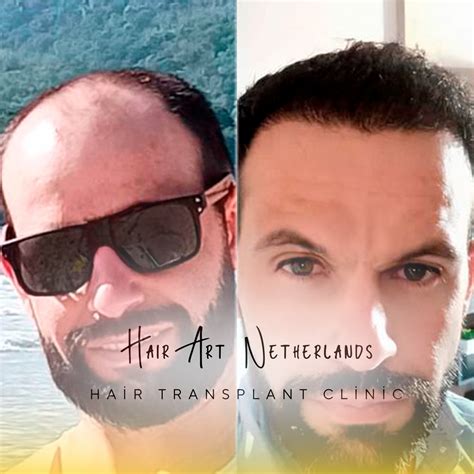 Hoe Kies Je De Beste Haartransplantatie Methode Voor Jou?