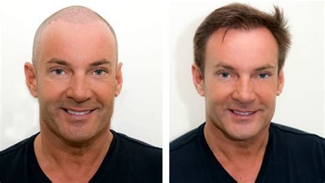 Voor-En NA Foto’s Van Haartransplantatie: Inspirerende Transformaties